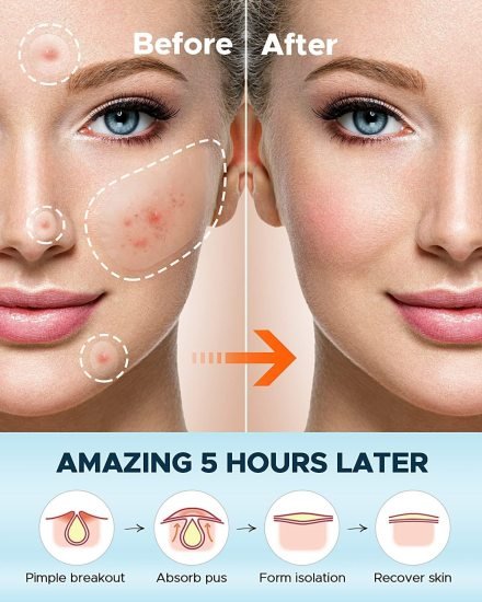 36 pcs  Acne Patch Pimple Patch Beauty Products